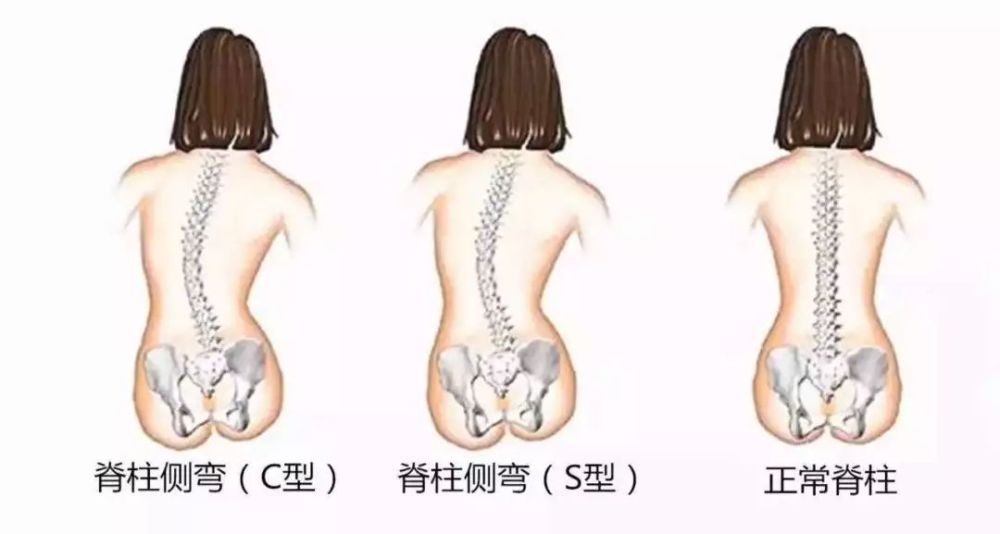 最新脊柱側彎治療方法及其奇妙之旅