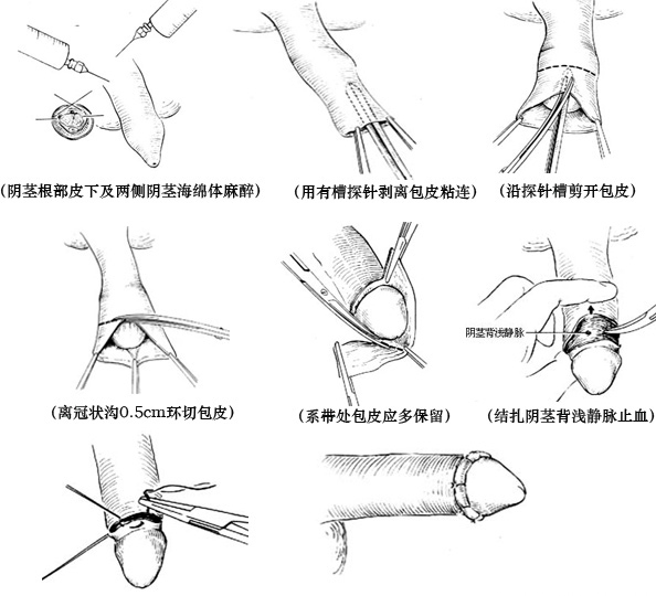 包皮手術創新技術引領健康生活新時代，科技之光重塑醫療領域