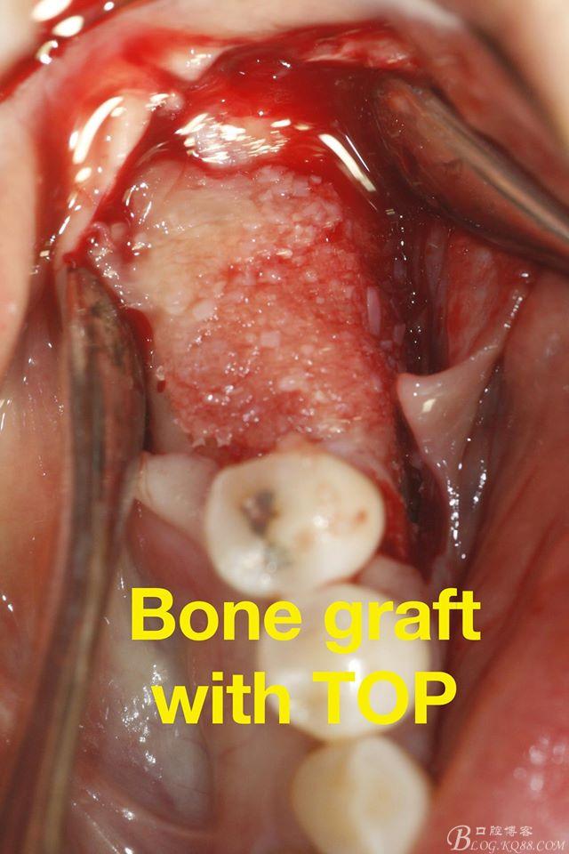 最新再生牙技術,笑迎人生,勇敢追求學習與變化的力量